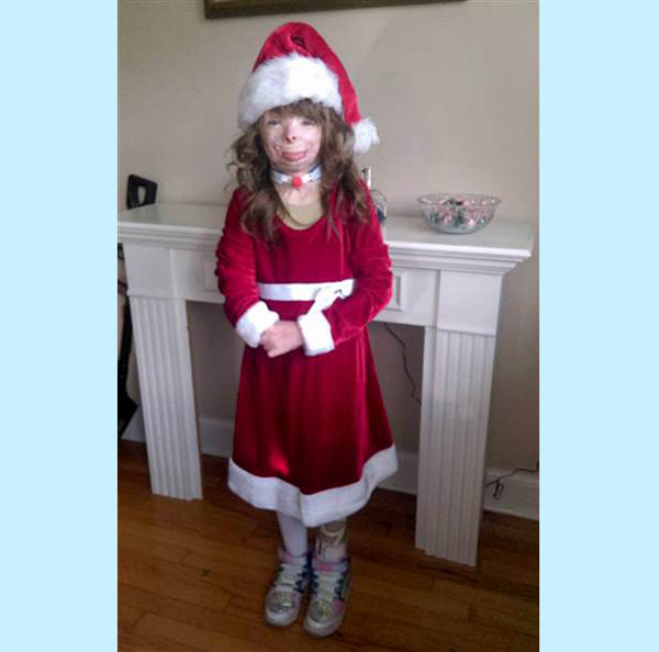 girl burned in fire wants Christmas cards