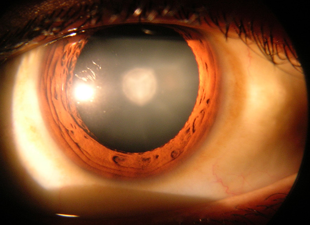 cataracts surgery fix