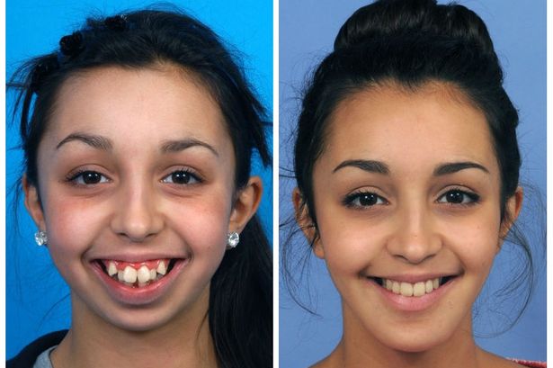 girl has amazing transformation teeth surgery