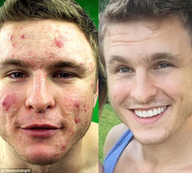 get rid of acne by going vegan