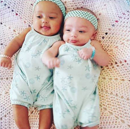 twins born different color skin