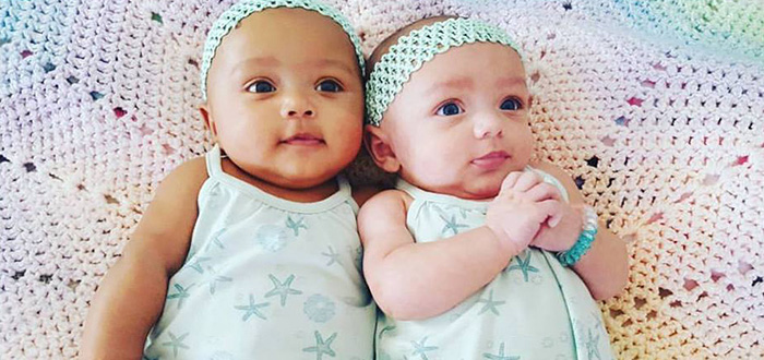 twins born different color skin