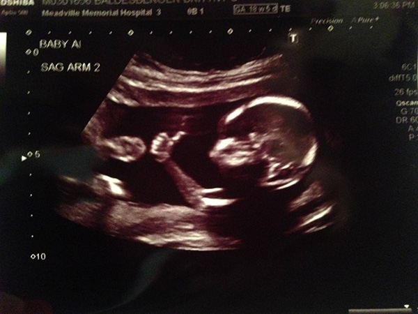 ultrasound thumbs up