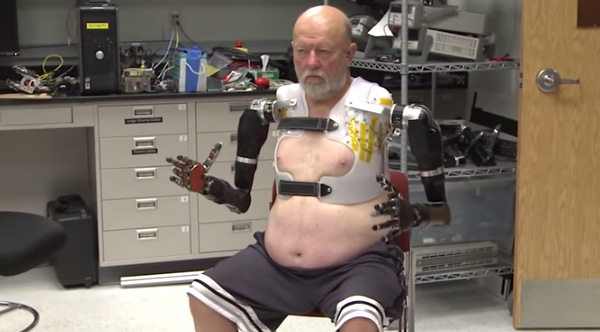 man with no arms gets robot arms