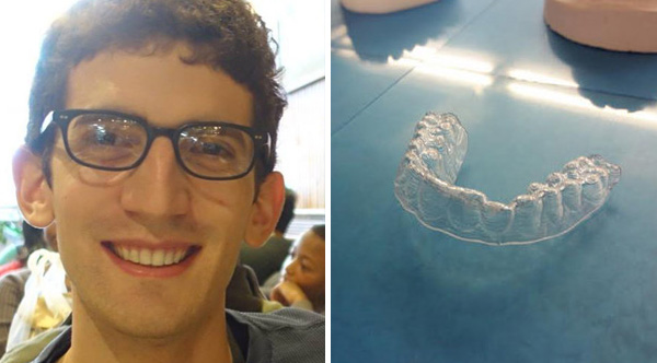 This College Student's 3DPrinted Braces Cost Him 60, And His Teeth