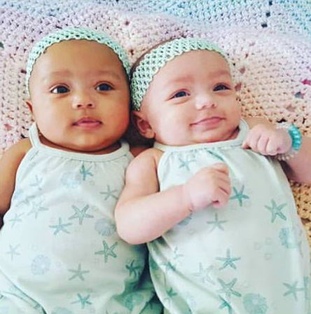 twins born different color skin