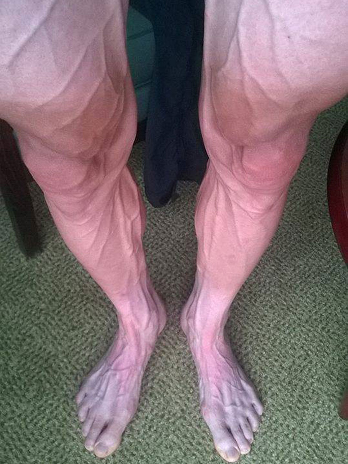 cyclist legs after tour de France veins