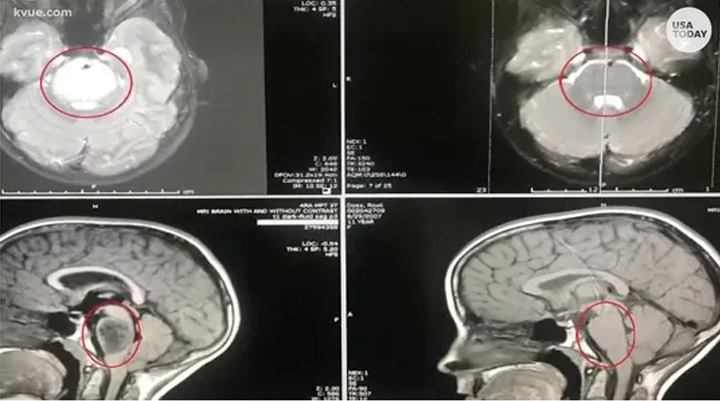 brain tumor vanishes little girl