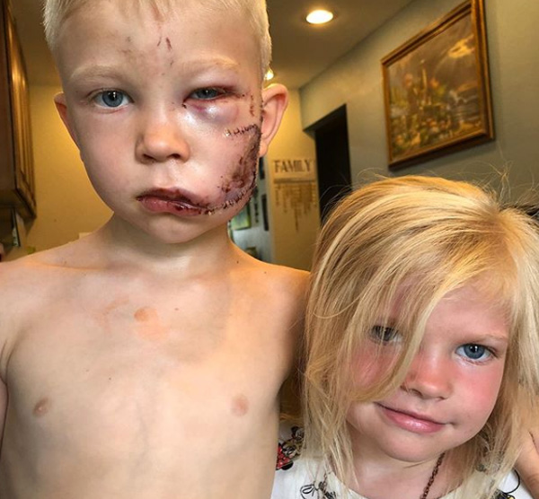 boy saves sister from dog attack