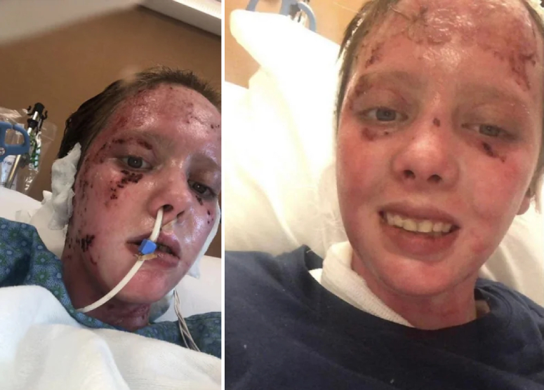 young woman burned badly shares good news updates
