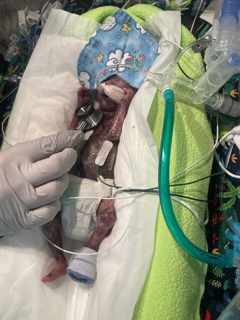premature baby world record