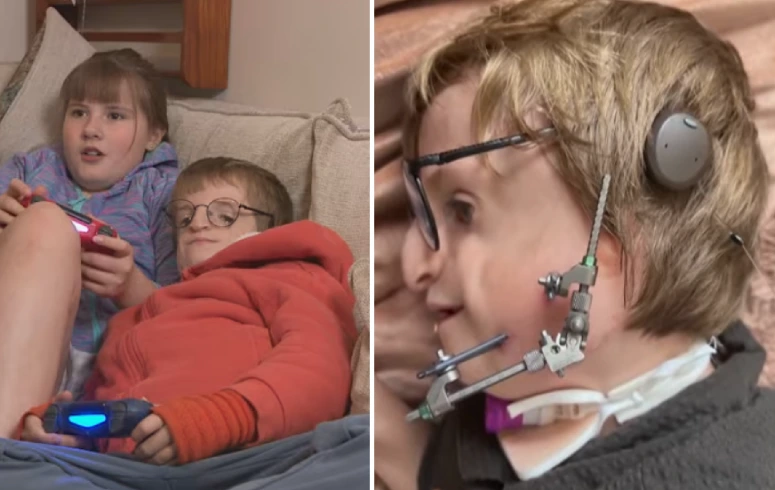 boy has jaw fixed with bone from ribs